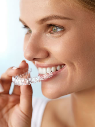 clear aligners